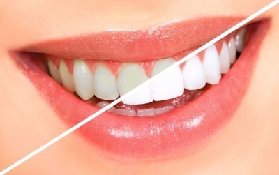 professional teeth whitening sugar land to lighten shade