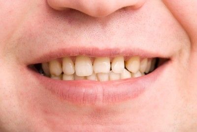 chipped teeth