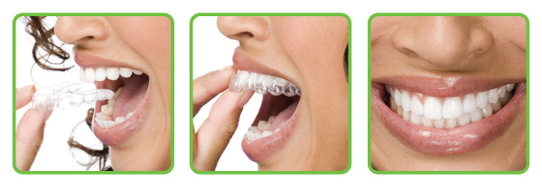aligners for teeth