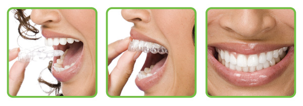 invisible aligners