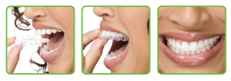 invisible teeth aligners