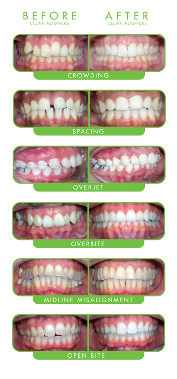 ClearCorrect Clear Aligner Orthodontics