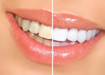 making your teeth white