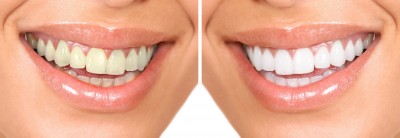 zoom whitening