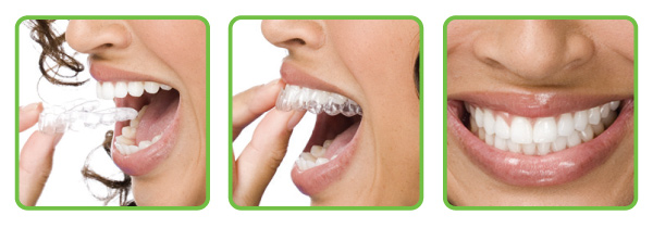 clear aligner orthodontics