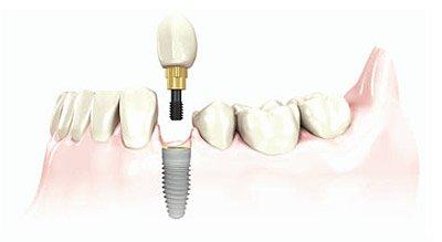 Sugarland TX dental implant center