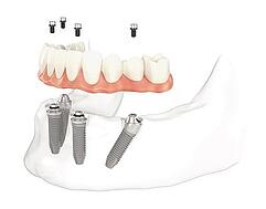all-on-4-dental-implants-lower-jaw