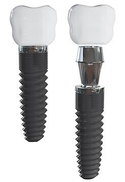 single-tooth-dental-implants_8703910_s
