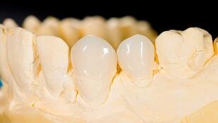 31210139_s_cost-of-porcelain-veneers