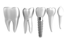 affordable dental implants-27725172_s