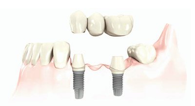 multiple-teeth-dental-implants
