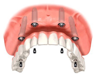 denture implants cost