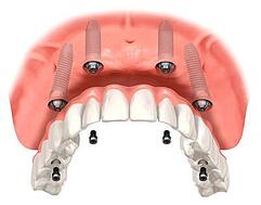 dental implants dentures all-on-4-upper-jaw