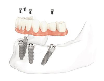 denture implants cost