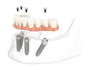 all-on-4-lower-jaw full mouth dental implants