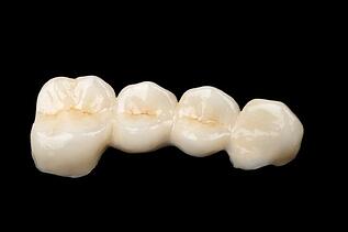 dental bridges 19832585_s