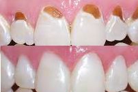 6648531_s_repairing-tooth-enamel