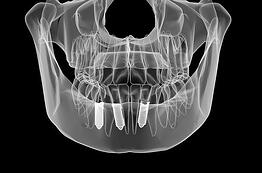 29262752_s_dental-implant-procedure