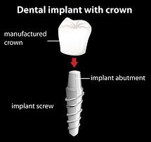 26570910_s_cost-of-denta-implants