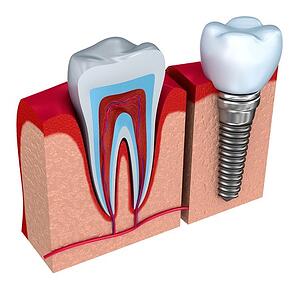 32591656_s_dental implants procedure