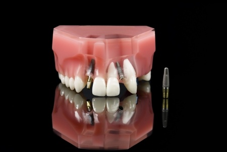 dentist implants-6721294_s