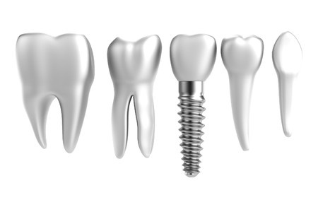 affordable dental implants-27725172_s