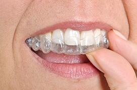 teeth alignment_30682817_s
