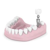 teeth implants_21773109_s