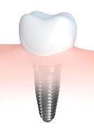 tooth implant 16671007_s