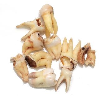 dental diseases