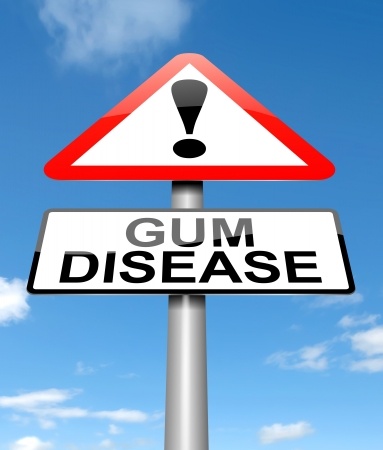 gum_disease_19006366_s