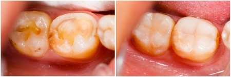 tooth_filling