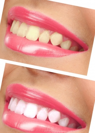 teeth bleaching_21761699_s