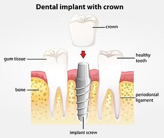 20679958_s_dental_implant