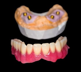implant supported dentures 31417325_s-1