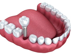 dental implant services 40005772_s