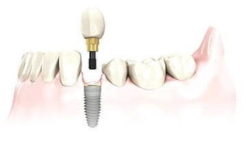 single tooth dental implants