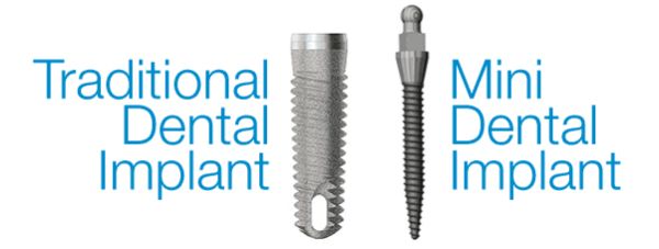 mini-dental-implants